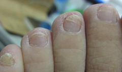 灰指甲用什么有效？知足抗菌足膜能根治